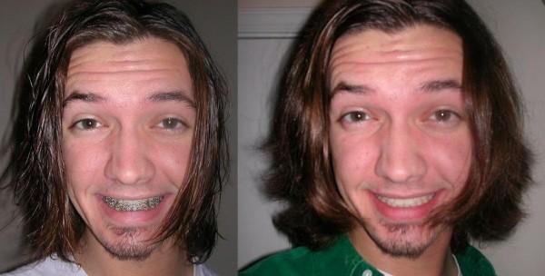 The Before with Braces and After with Lower Jaw Surgery