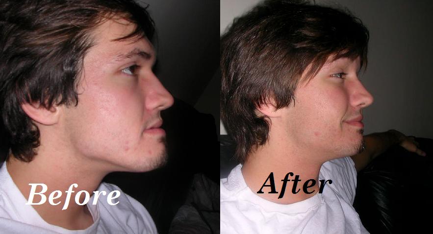 The Cost of Before and After Lower Jaw Surgery